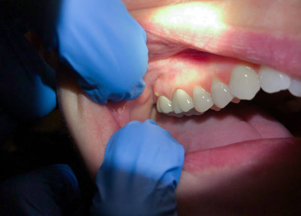 Best Emergency Dental Care for Broken or Chipped Teeth in River Ridge, LA
